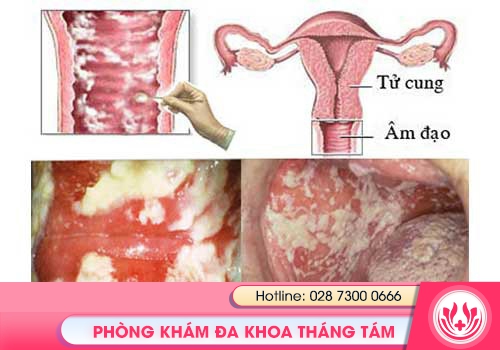 Viêm âm đạo, viêm cổ tử cung gây vô sinh ở nữ giới