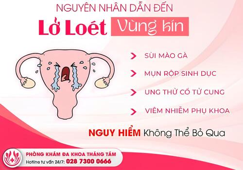 loét vùng kín