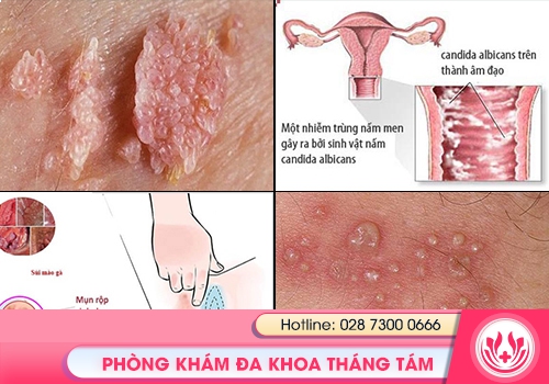 loét vùng kín